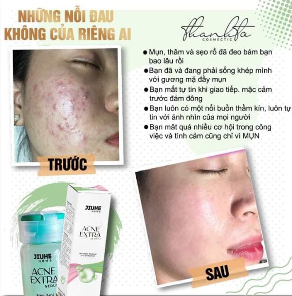 Serum mụn acne extra jiuhe chính hãng