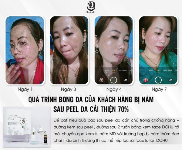 Combo Dohu Vi Tảo phục hồi da chính hãng MD Beauty - 8938510826440